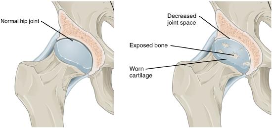 Frontal view of normal hip joint and hip joint with deteriorated articular cartilage