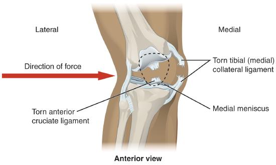Anterior view of knee with torn anterior cruciate ligament and torn medial collateral ligament