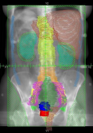 Whole abdomen treatment field.