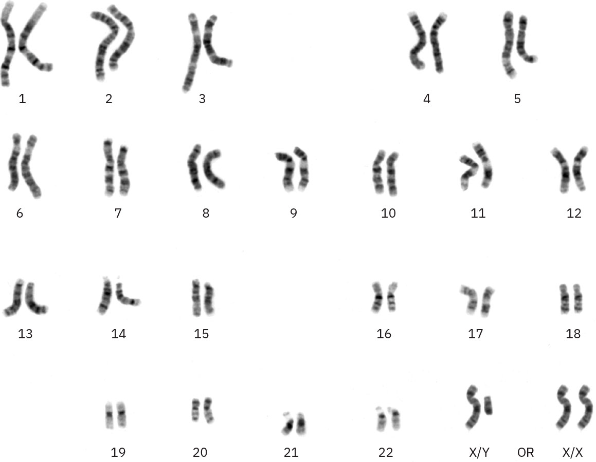 Image of autosomes (body cell chromosomes) and sex chromosomes (XX or XY).