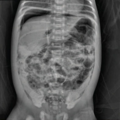 An x-ray image of an infant shows gas patterns within the intestinal wall characterized by dark, circular areas against the denser background of the abdomen. The patterns are irregularly distributed throughout the intestine.