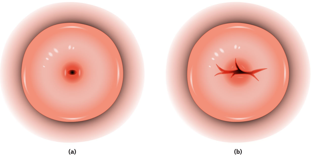 Diagram of cervical os showing (a) round and small and (b) slit.