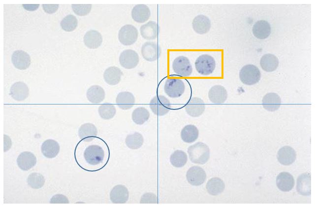 Feline blood film with 42 total RBC and 2 aggregated reticulocytes. The yellow square=punctate. The blue circle=aggregate