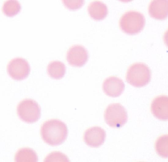 7.2: Blood Smear Examples - Medicine LibreTexts