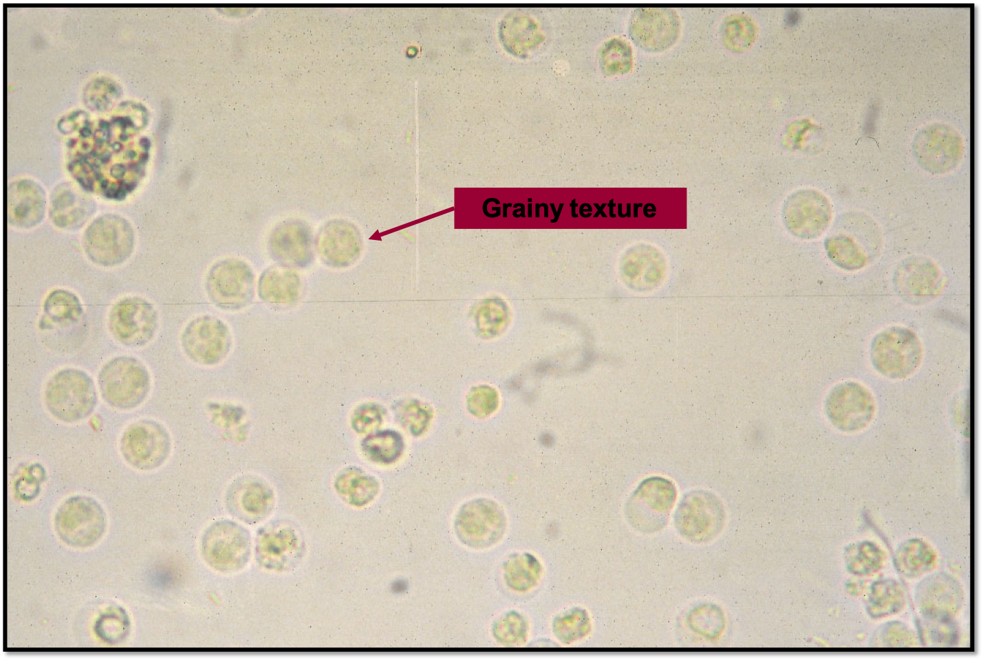 Microscopic Urinalysis Wbc And Rbc Bacteria