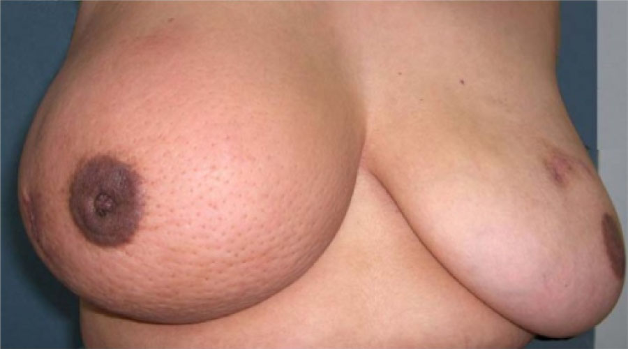 A photograph shows a pair of breasts with the right breast displaying a dimpled pattern.