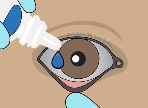 A close-up illustration of a provider pulling down a patient’s eyelid while applying eye drops.