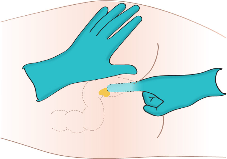 Illustration of person lying on their side. A gloved hand supports their right buttock while another gloved hand inserts medication into the rectum with the pointer finger.