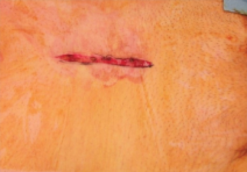 Example of an acute wound.