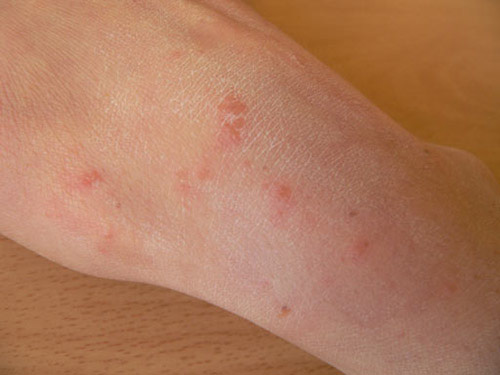 A photograph of scabies