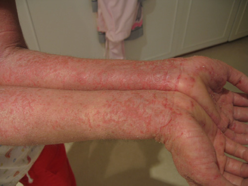 A color photograph showing eczema on the arms and hands