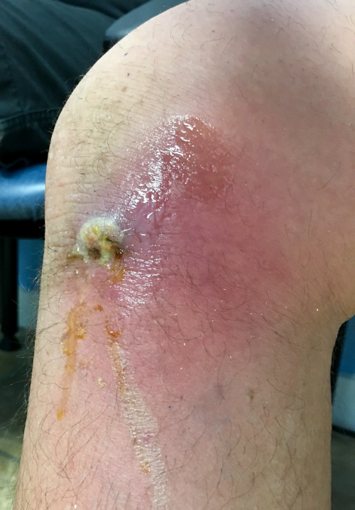 A color photograph of a leg with a staph infection