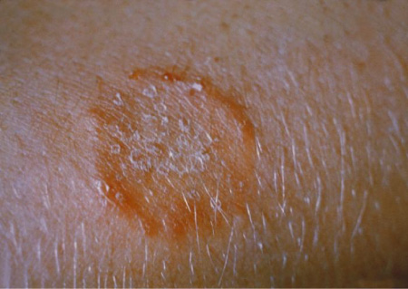 A photograph of a ringworm under the skin shown as a red ring on the surface of the skin.