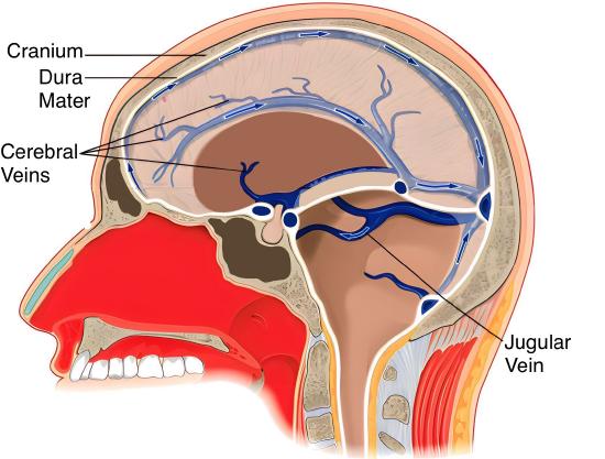 Cross-section diagram of a human head highlighting veins, including the cavernous veins, and dura mater. The jugular vein is labeled along the neck area, with bone and tissue structures visible.