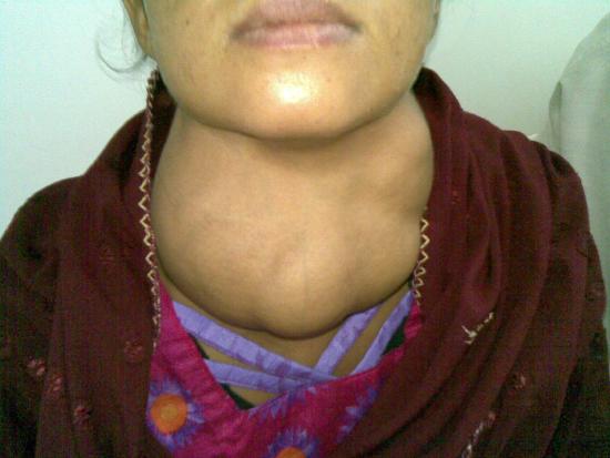 7.12: The Thyroid Gland - Medicine LibreTexts