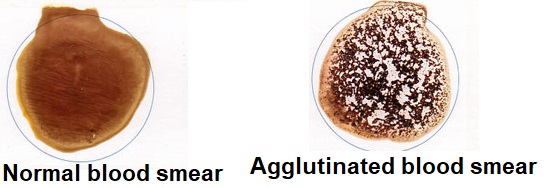 Comparison of two blood smears: normal blood smear with a smooth appearance on the left, and agglutinated blood smear with clumps on the right.