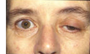 Drooping eyelid in a myasthenia gravis patient