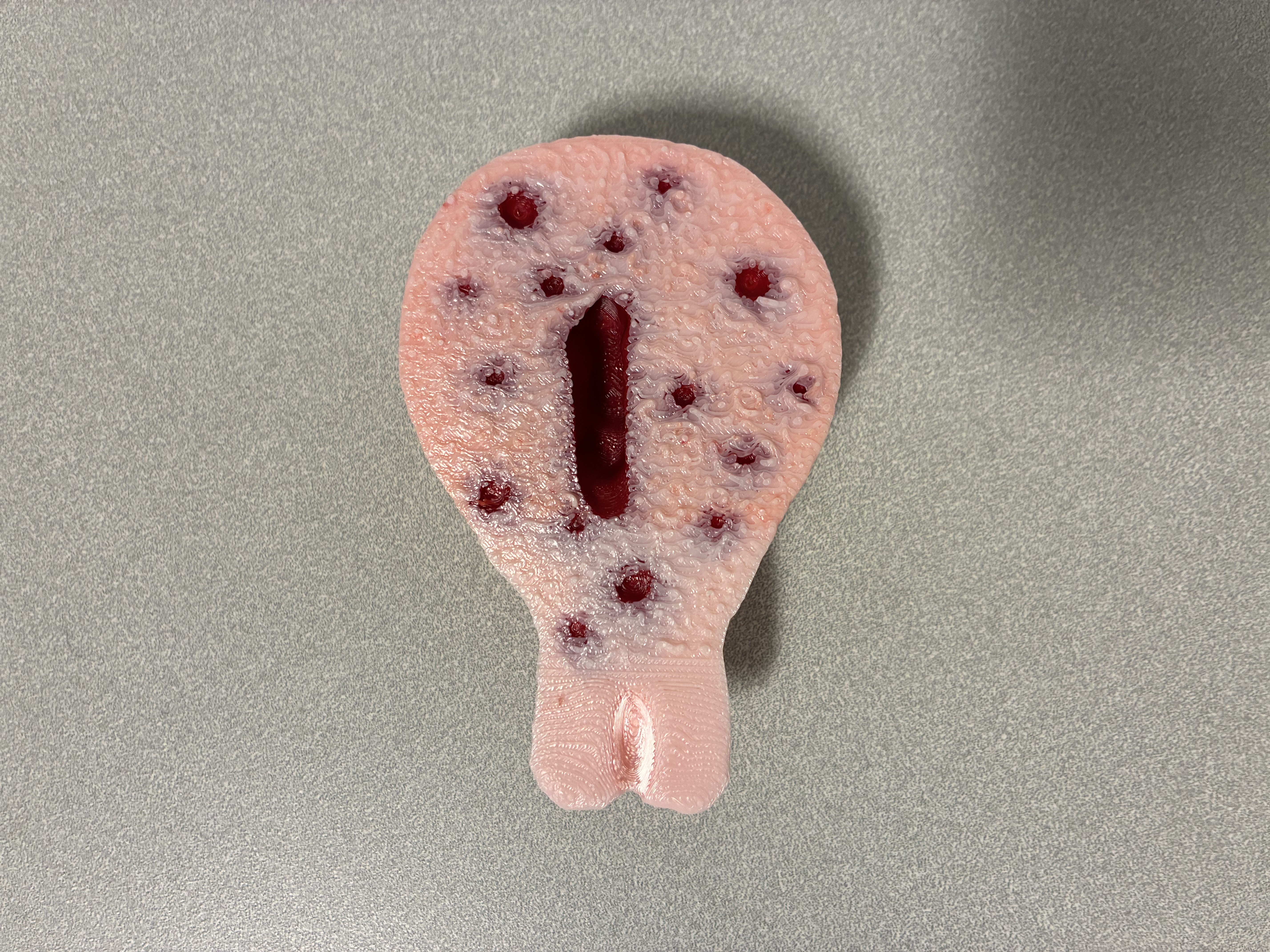 Adenomyosis.jpeg