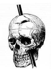 Drawing of a skull with a rod piercing the top right and exiting just under the left eye socket