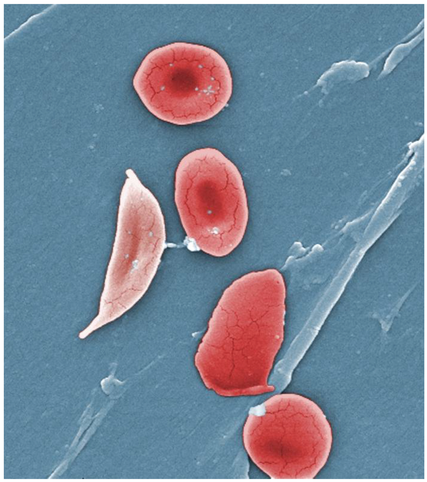 Normally shaped red blood cells described as biconcave discs in view with a sickled red blood cell shaped like a crescent moon.