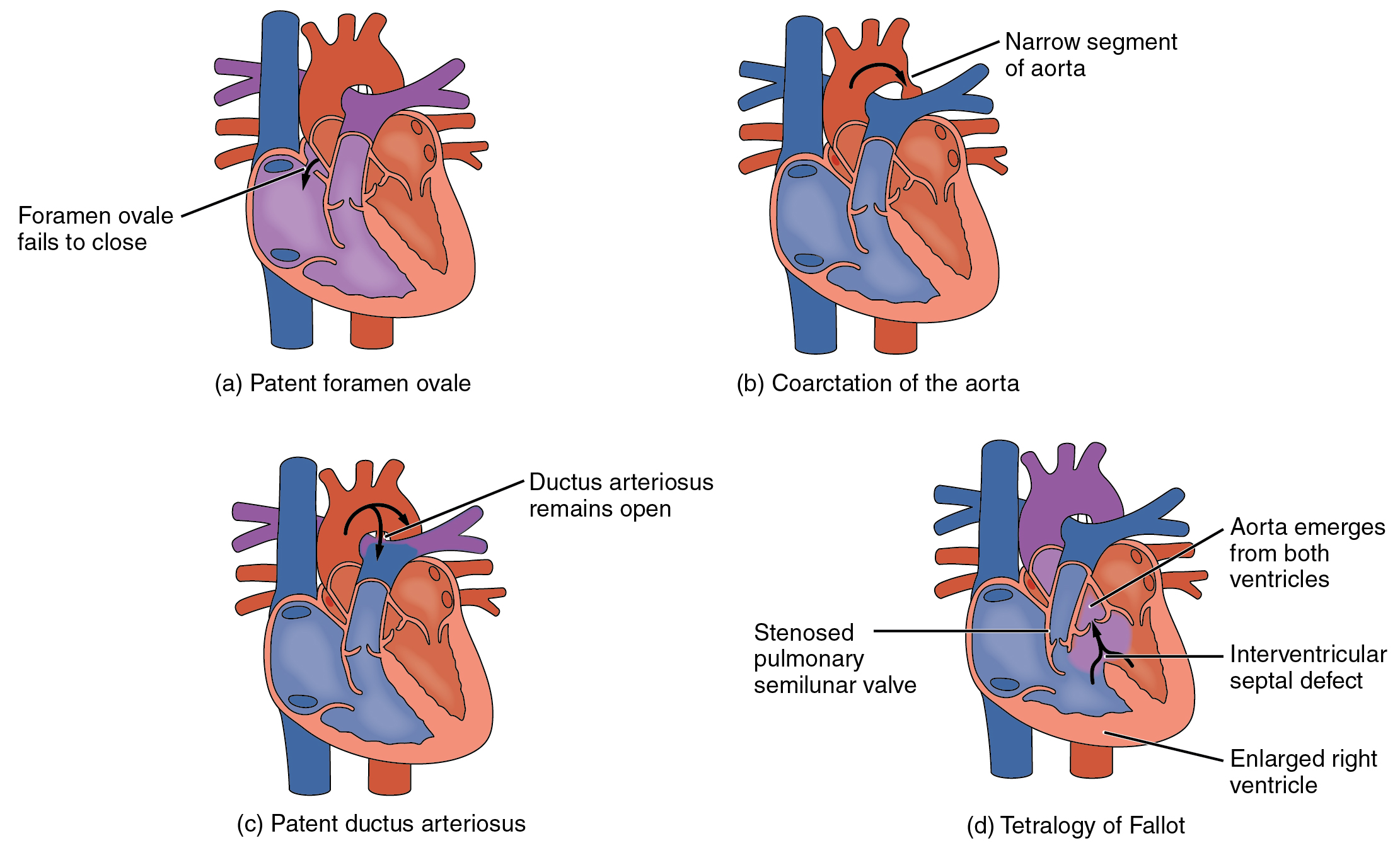 Diagrams illustrating the abnormal anatomy associated with several common congenital defects of the heart.