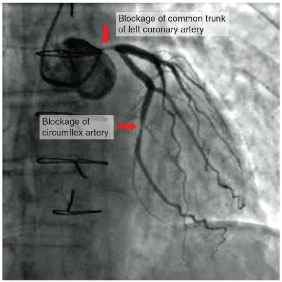 Coronary angiogram showing two blockages in coronary arteries that visibly restrict blood flow through the areas.