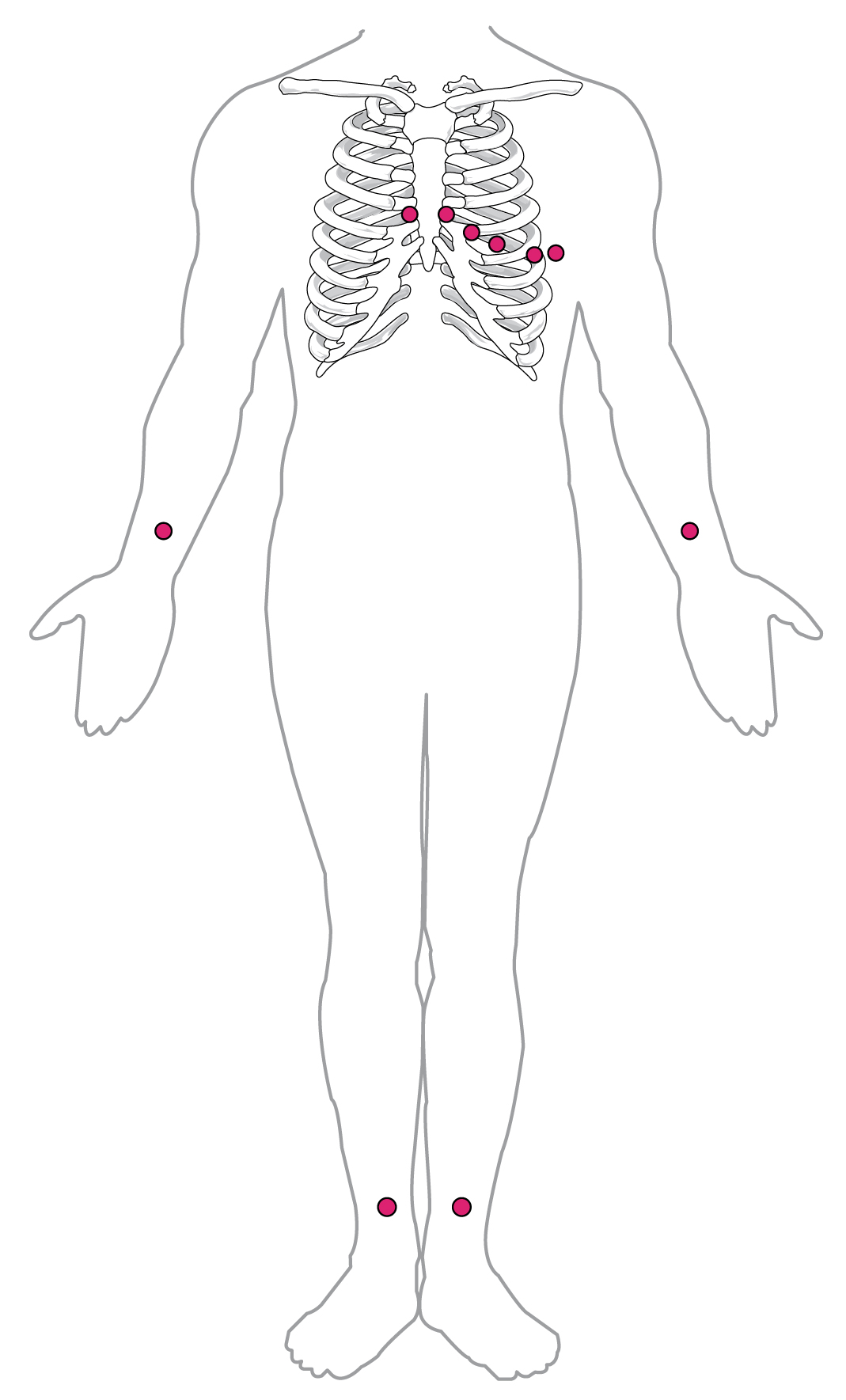 Red dots show the placement of 10 leads for a 12-lead ECG: 6 leads are placed about 2 fingers apart in a curved line pattern starting just to the right of the sternum about 3 fingers above the xyphoid process, straight across the midline to the same position on the left side of the sternum, then curving downward across the left side of the rib cage for the remaining 4 leads of that set. Additional leads are placed on the anterior surface of both wrists and the medial surface of both ankles.
