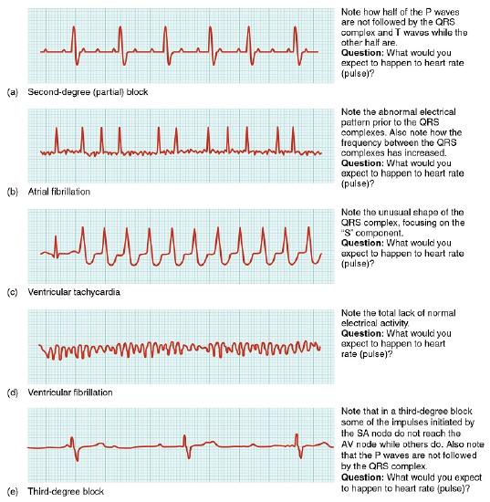 Different types of cardiac arrhythmias