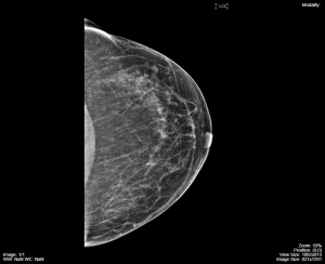 Mammography-images-a-300x244.png
