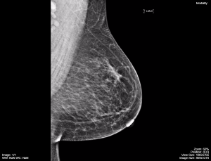mammography-images-b-300x229.png