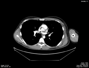 CT-of-chest-on-mediastinal-window-and-level-300x229.png