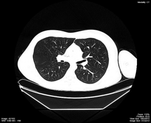 CT-of-chest-on-lung-window-and-level-300x244.png