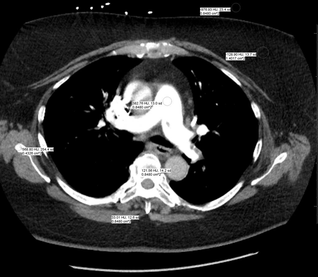 Images-of-CT-with-HU-measurements-1024x892.jpg