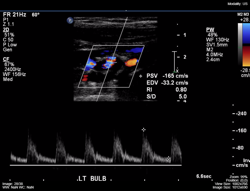 Carotid-doppler-ultrasound-2.png