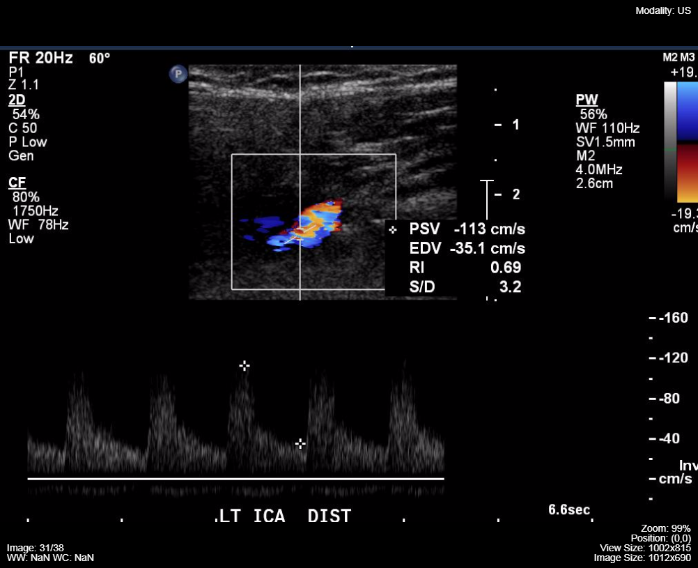 Carotid-doppler-ultrasound-1.png