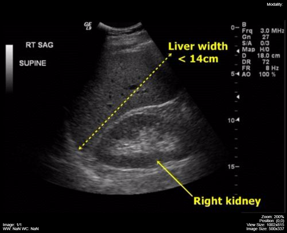 ultrasound-image-of-the-normal-echogenicity-of-the-liver-and-the-lower-echogenicity-adjacent-renal-cortex.png