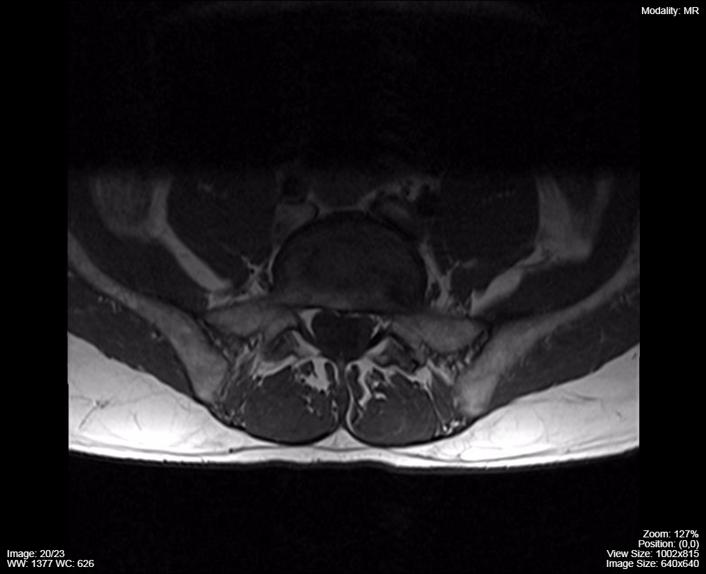 Lumbar-spine-MRI-T1-sequence.png