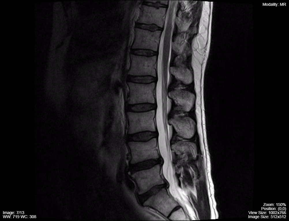 Lumbar-spine-MRI-T2-sequence-sagittal.png