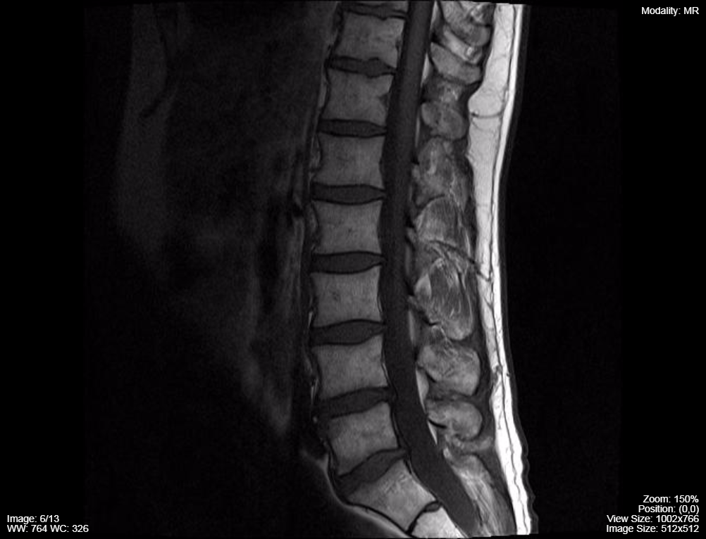 Lumbar-spine-MRI-T1-sequence-sagittal.png