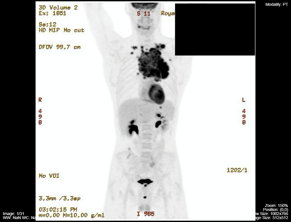 PET-CT-lymphoma-2.png