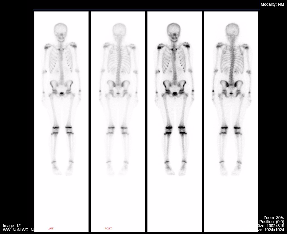 normal-pediatric-nuclear-medicine-bone-scan.png