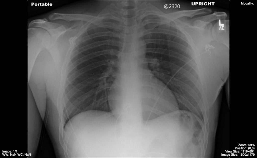 5 2 Approach To The Chest X Ray Cxr Medicine Libretexts