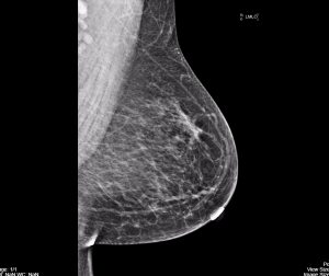 normal-mammography-2-e1502466131862-300x252.png