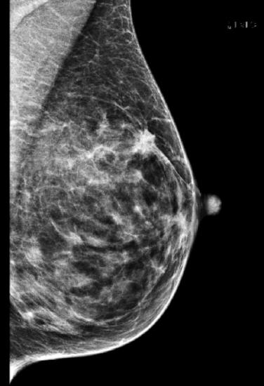 breast-case-1-3-1.jpg