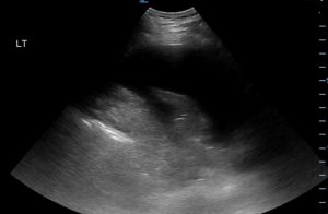 pleural-effusion-ultrasound-atelectasis-300x196.jpg