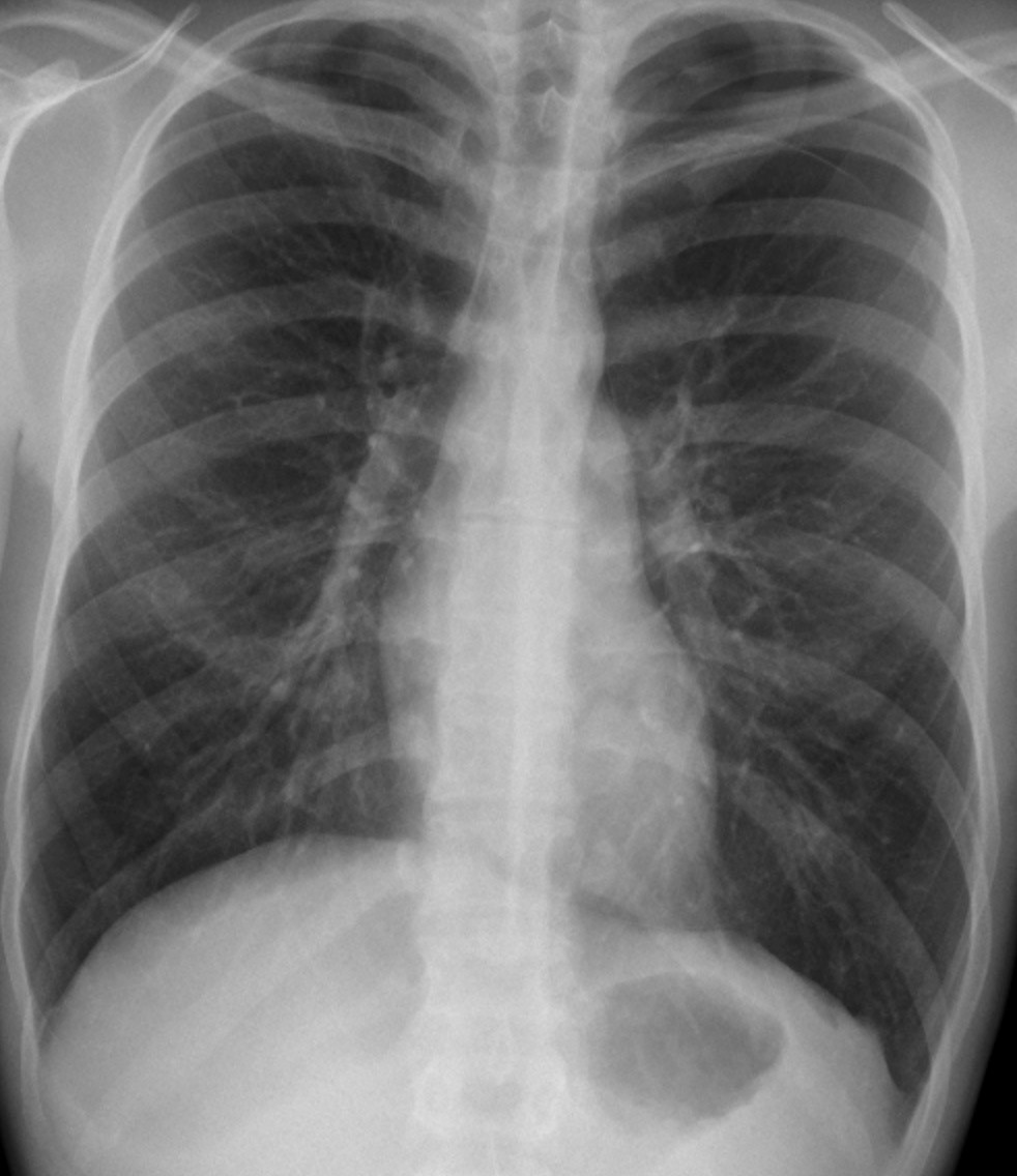 Chest X Ray Pneumothorax
