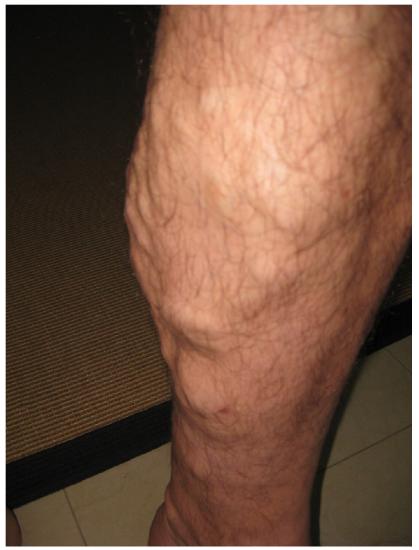 Photograph of left leg with varicose veins visible as lumps under the skin.