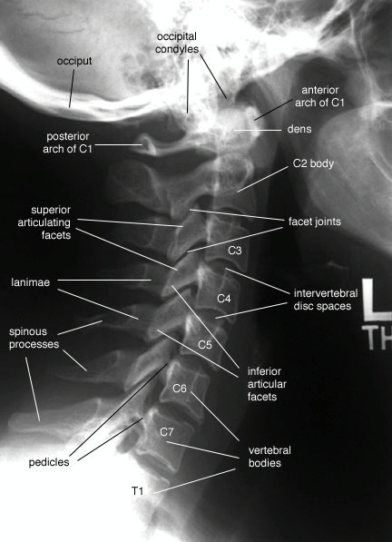 Lateral-Cspine-labelled-adult.jpeg