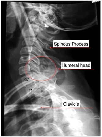Swimmers-Cspine-labelled.jpeg