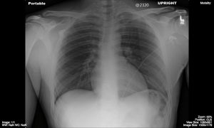 Normal-AP-chest-x-ray-300x180.jpg